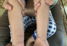 Столичные врачи прокомментировали ситуацию с аллергией на укусы комаров у детей Столичные врачи прокомментировали ситуацию с аллергией на укусы комаров у детей